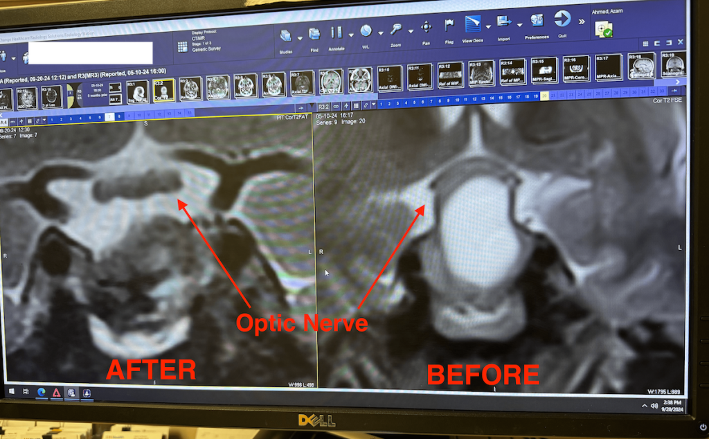 MRI showing the optic nerve being stretched
